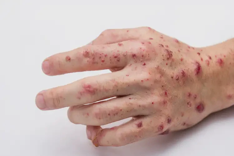 女人手上經(jīng)常長濕疹不管它會(huì)自己自愈嗎(圖4)