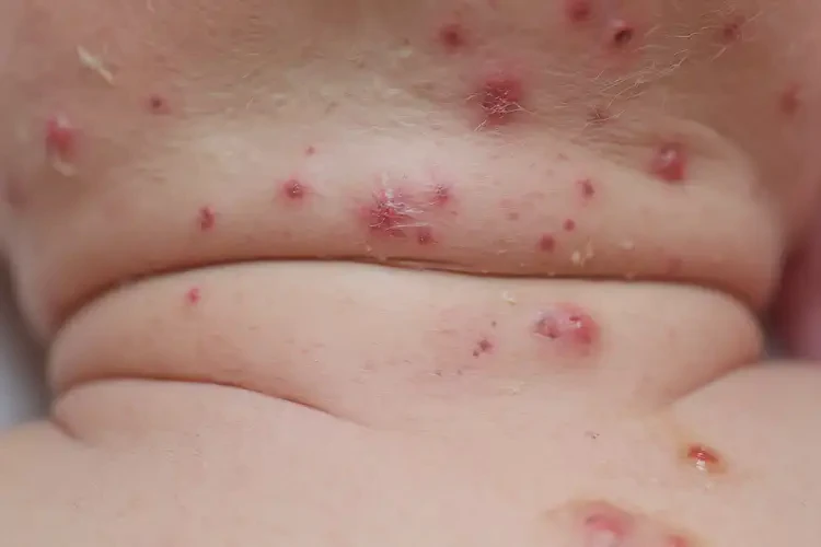 新生兒脖子出現(xiàn)濕疹可不可以徹底自愈(圖4)