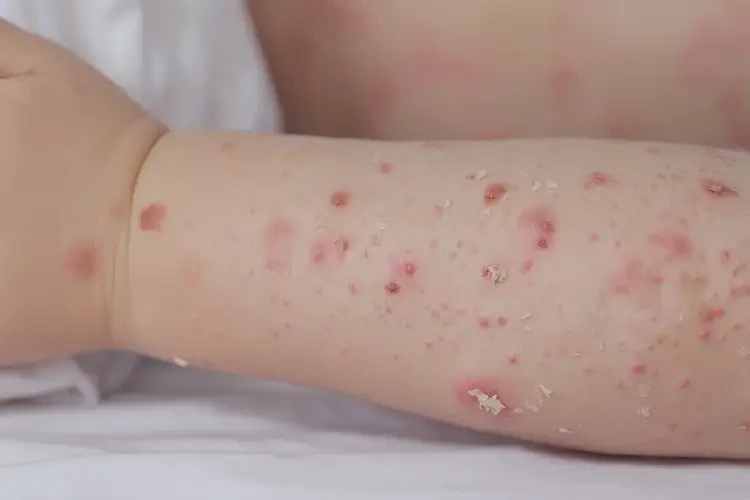 小兒四肢經(jīng)常起濕疹能徹底自愈嗎(圖4)