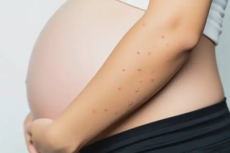 孕妇手臂上出湿疹不管它会自己自愈吗(图2)