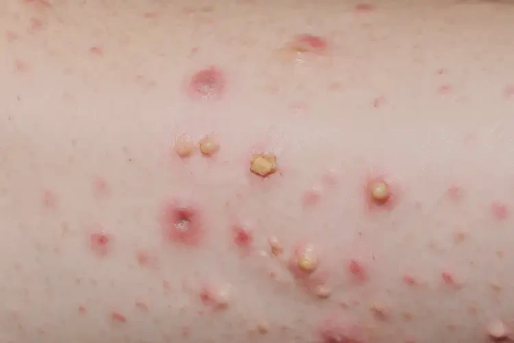 青少年四肢經(jīng)常起濕疹可不可以徹底自愈(圖4)