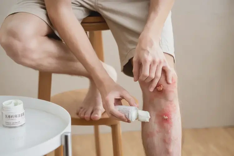 青少年四肢經(jīng)常起濕疹可不可以徹底自愈(圖3)