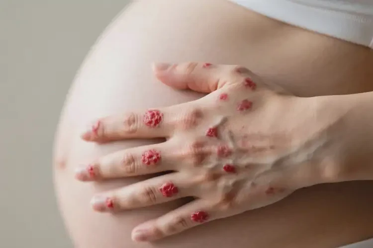 孕妇手上出现湿疹不管它会自己自愈吗(图3)