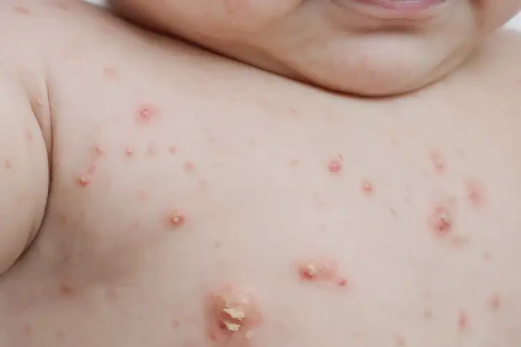 寶寶屁股上經(jīng)常起濕疹不管它會自己好嗎(圖4)