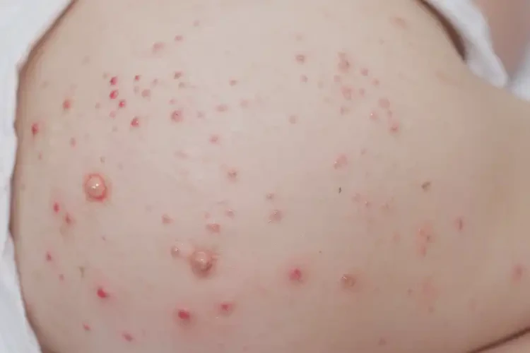 少兒屁股上經(jīng)常長(zhǎng)濕疹能徹底自愈嗎(圖4)