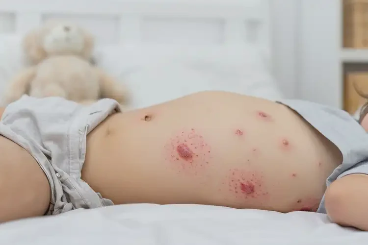 女生肚子上經(jīng)常起濕疹能徹底自愈嗎(圖4)