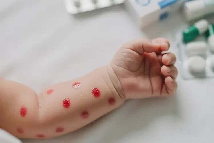 新生兒手臂上容易長(zhǎng)濕疹不管它會(huì)自己痊愈嗎(圖2)