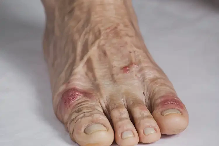 高齡老人腳上經(jīng)常長(zhǎng)濕疹不管它會(huì)自己痊愈嗎(圖4)