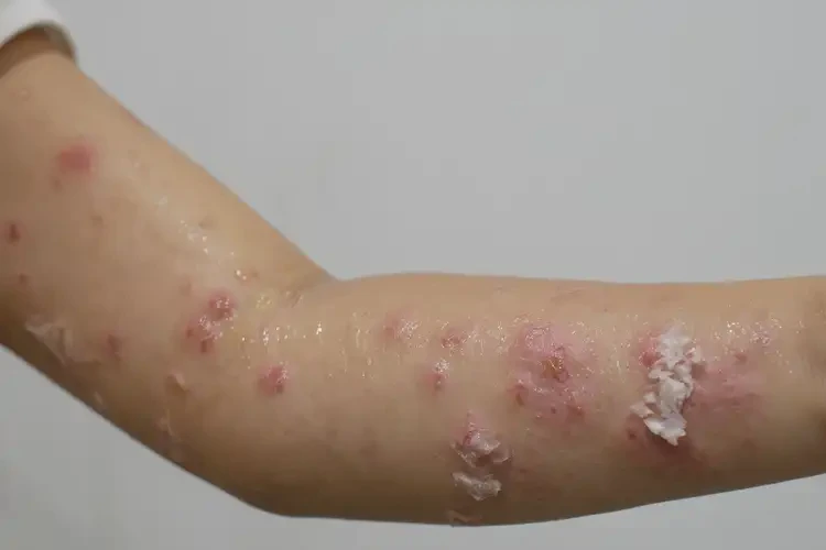 少兒手臂長(zhǎng)濕疹不管它會(huì)自己自愈嗎(圖1)