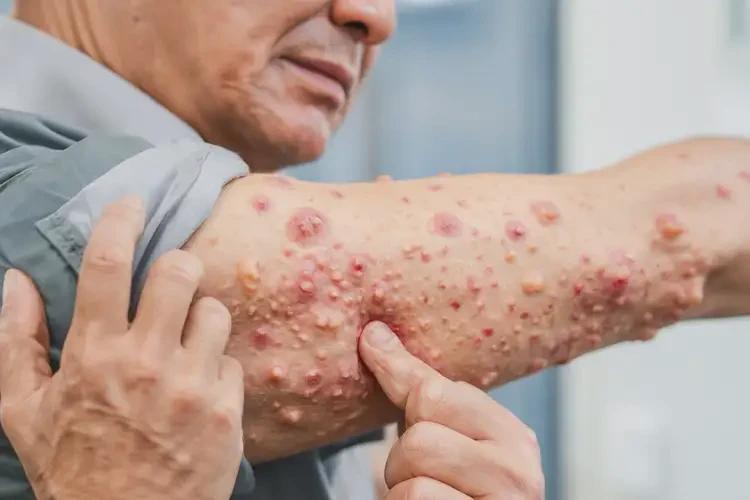 男性手臂上起濕疹不管它會自己痊愈嗎(圖4)