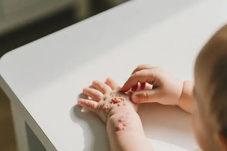 小兒手上容易長濕疹不管它會自己好嗎(圖2)