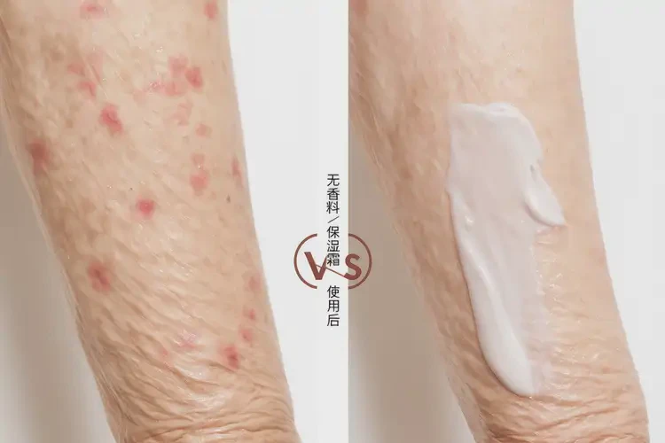 高齡老人手臂上經(jīng)常起濕疹可不可以徹底自愈(圖2)