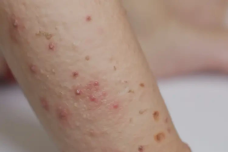 小兒手臂上容易長濕疹能夠徹底治愈嗎(圖4)