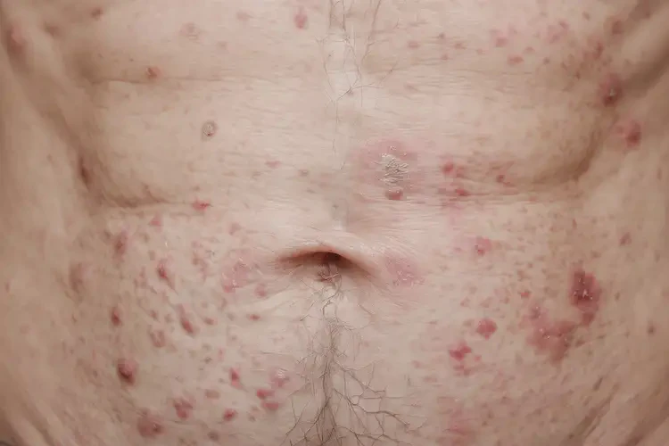 老年人肚子上有濕疹能不能徹底自愈(圖4)