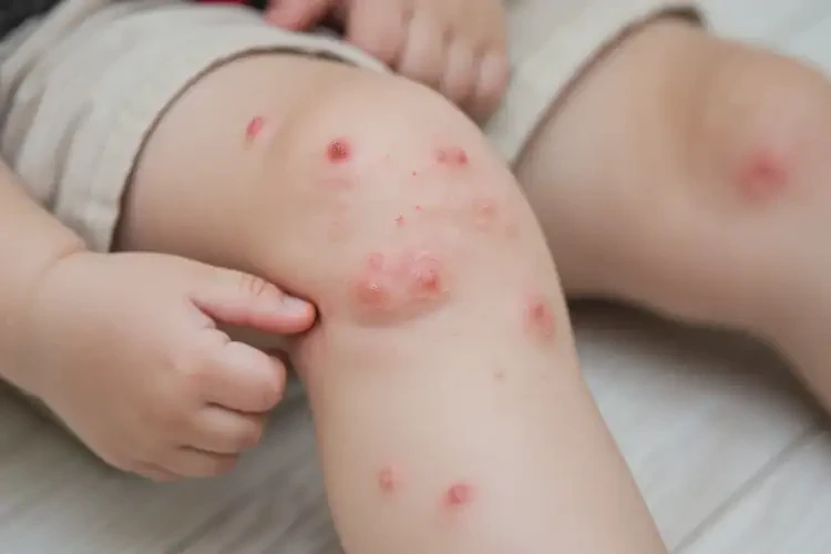 小兒小腿長(zhǎng)濕疹能徹底自愈嗎(圖4)