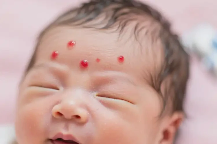 新生兒面部出濕疹不管它會自己痊愈嗎(圖1)