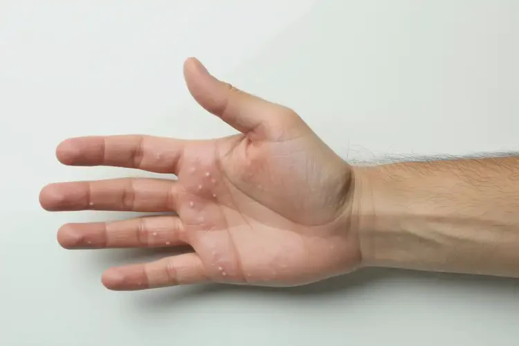 男性四肢偶爾長濕疹不管它會(huì)自己自愈嗎(圖2)