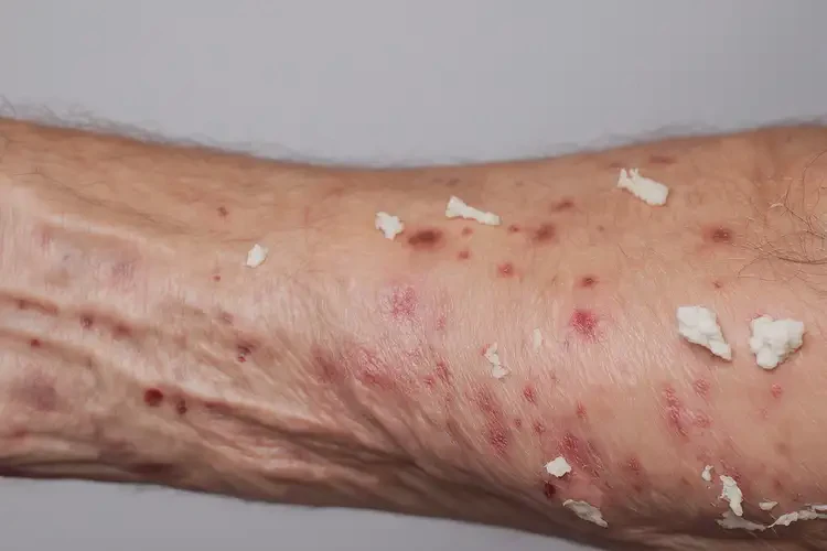 高齡老人手臂上經(jīng)常起濕疹可不可以徹底自愈(圖4)