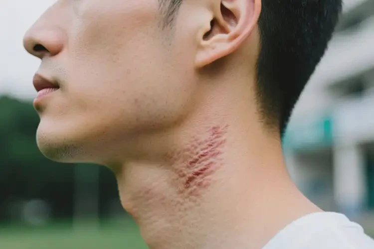 男人脖子有濕疹能不能徹底自愈(圖2)