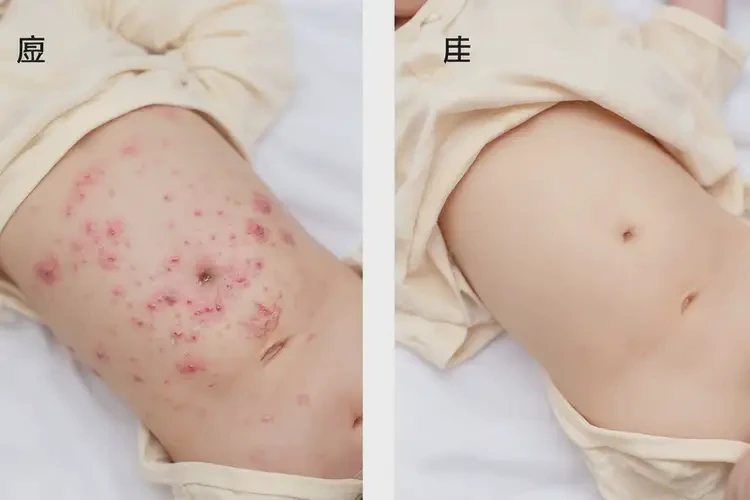 嬰幼兒肚子出濕疹能夠徹底治愈嗎(圖2)