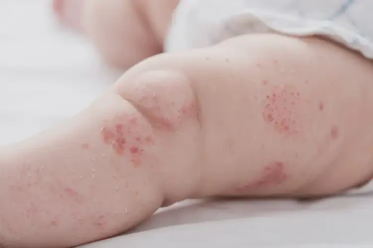 嬰兒大腿起濕疹能靠自己自愈嗎(圖4)