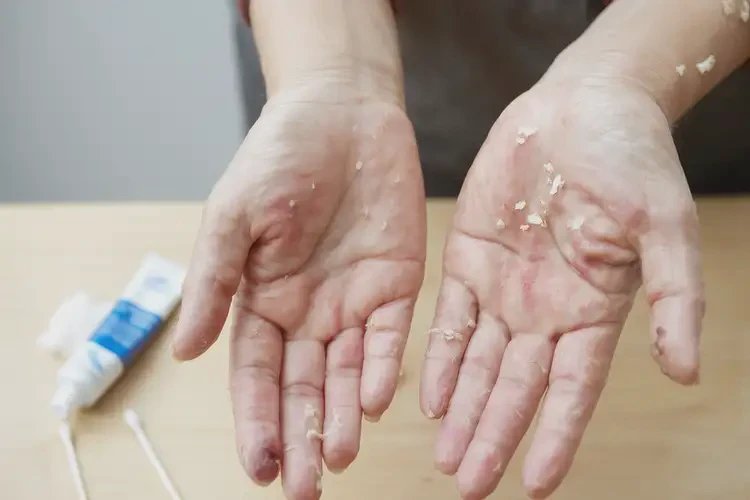 大學生手上起濕疹不管它會自己痊愈嗎(圖4)
