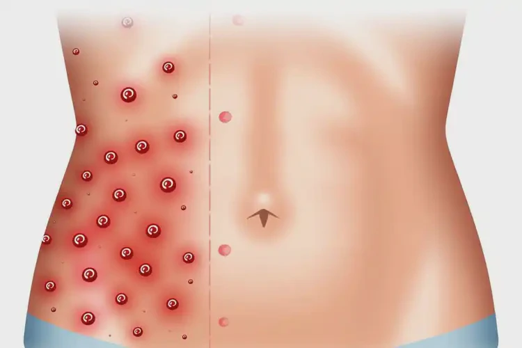 青少年肚子上起濕疹能徹底自愈嗎(圖1)