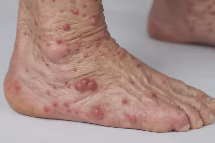 老年人腳上出濕疹不管它會(huì)自己好嗎(圖4)