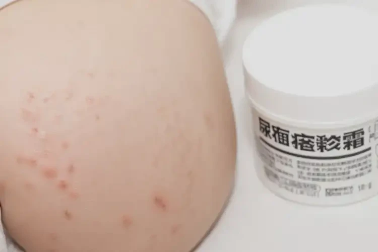 少兒屁股起濕疹能徹底自愈嗎(圖4)