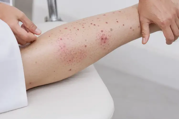 女人小腿容易起濕疹可以徹底自愈嗎(圖4)