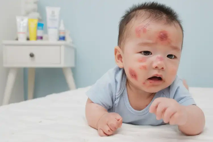 寶寶身上經(jīng)常起濕疹能靠自己自愈嗎(圖4)