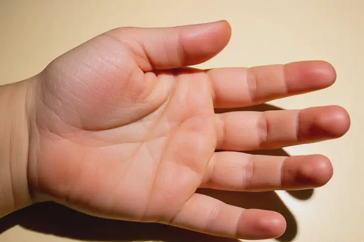 小兒手上長濕疹不管它會自己痊愈嗎(圖1)