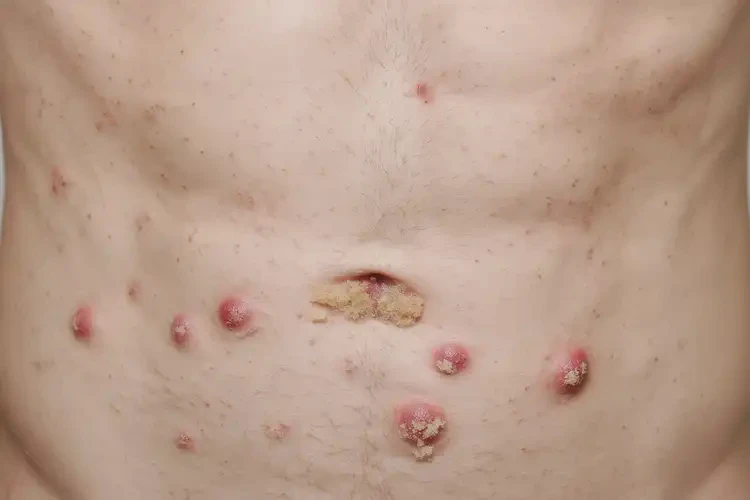 青年人肚子上長濕疹能不能徹底自愈(圖3)