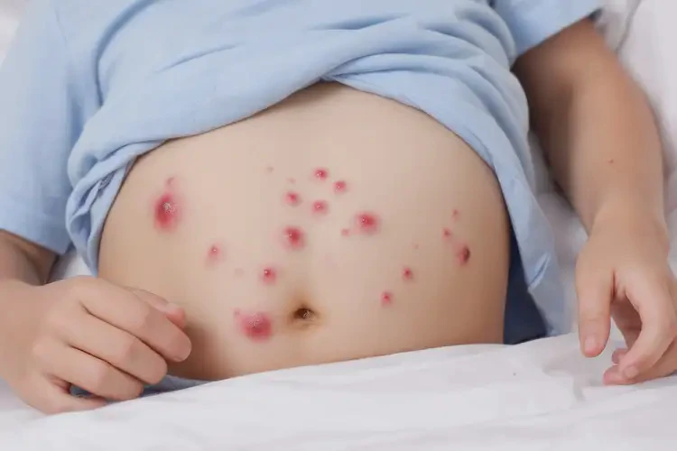 少兒肚子經(jīng)常起濕疹能徹底自愈嗎(圖4)