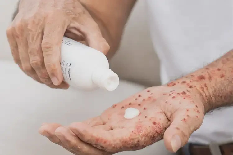 男生四肢容易起濕疹能徹底自愈嗎(圖4)