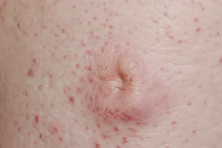 男人肛周經(jīng)常長濕疹不管它會自己痊愈嗎(圖4)