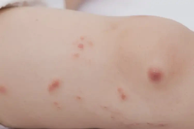 嬰幼兒大腿上出現(xiàn)濕疹不管它會自己自愈嗎(圖4)