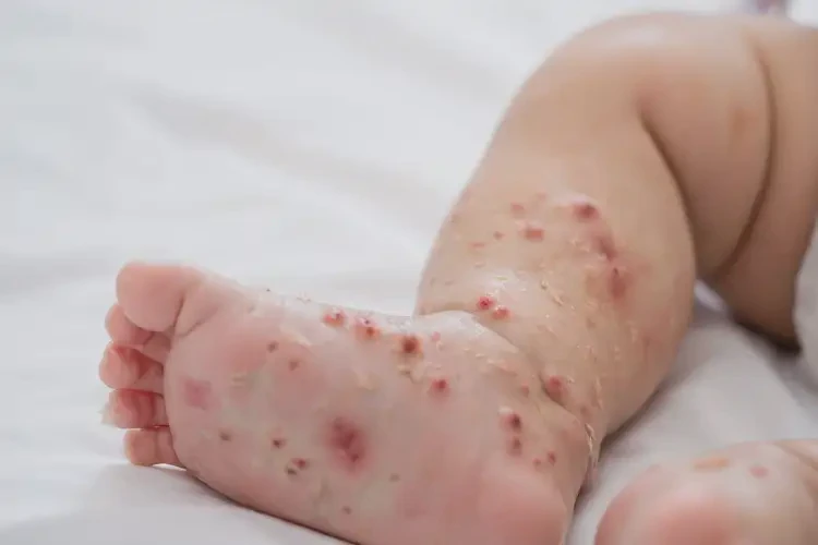小兒小腿上出現(xiàn)濕疹能靠自己自愈嗎(圖4)