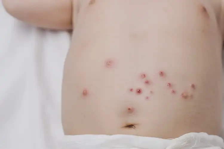 寶寶肚子容易起濕疹能夠徹底治愈嗎(圖4)