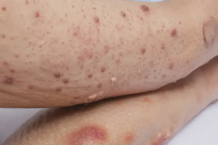 女性四肢出濕疹能夠徹底治愈嗎(圖4)