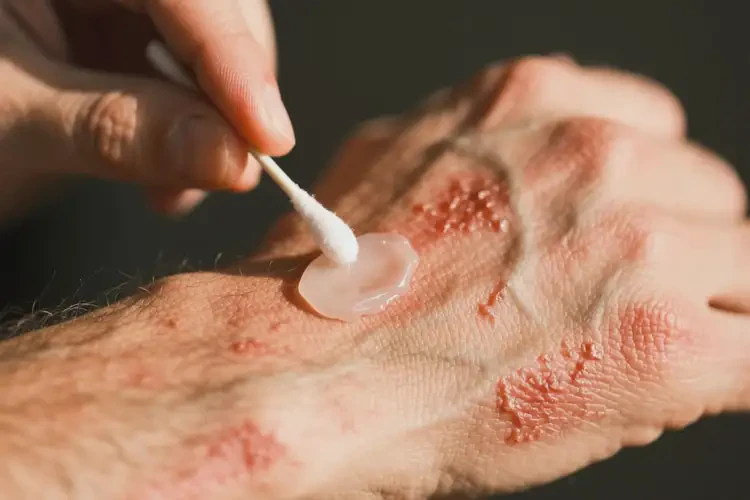 男性身上偶爾長(zhǎng)濕疹能夠徹底治愈嗎(圖3)