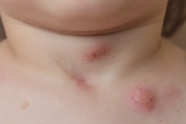 少兒脖子偶爾長濕疹可以徹底自愈嗎(圖4)