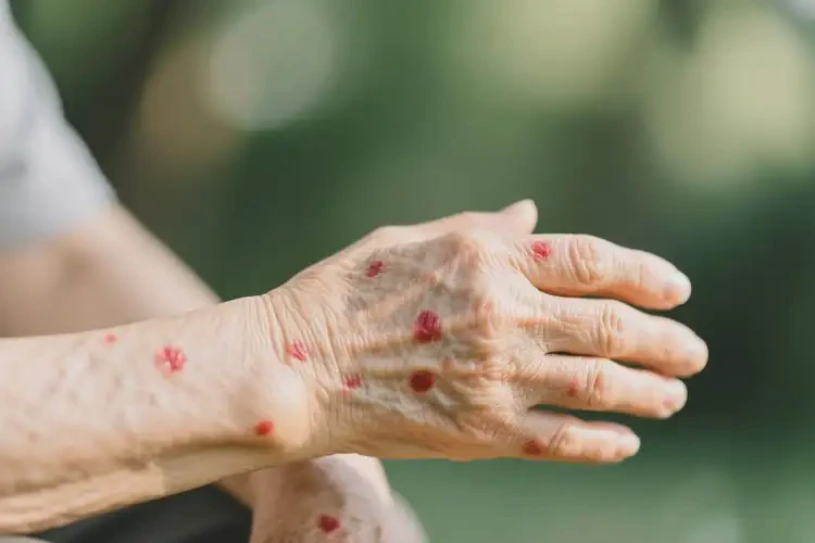 老人手臂偶爾起濕疹能徹底自愈嗎(圖1)