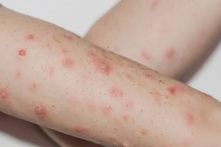 小學(xué)生手臂上容易起濕疹不管它會自己好嗎(圖4)