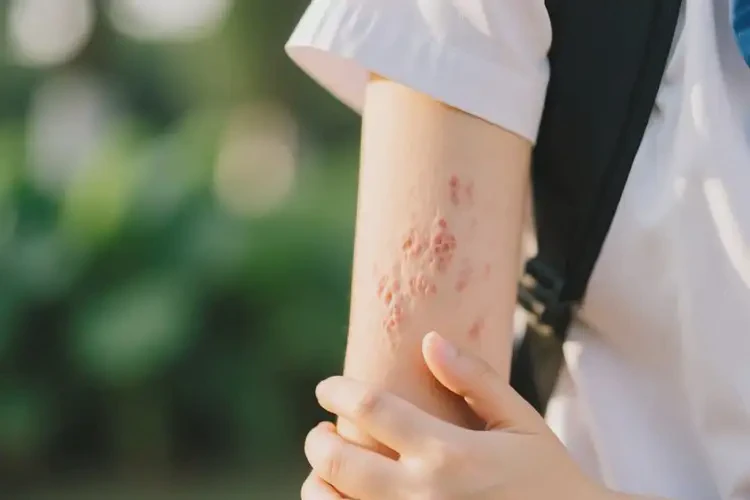 大學生手臂上出現(xiàn)濕疹能徹底自愈嗎(圖1)