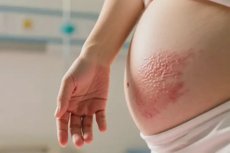 產(chǎn)婦手臂經(jīng)常長濕疹不管它會(huì)自己自愈嗎(圖4)