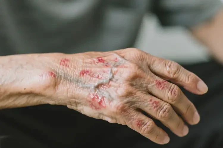 老人手臂出現濕疹不管它會自己痊愈嗎(圖3)