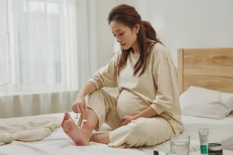 孕婦腳上容易長濕疹不管它會自己自愈嗎(圖3)