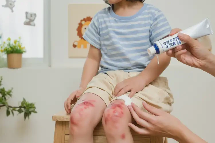 小孩大腿上經(jīng)常起濕疹不管它會(huì)自己自愈嗎(圖1)