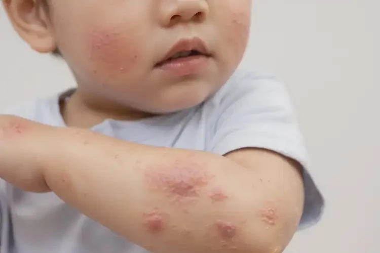 幼兒全身出現(xiàn)濕疹能靠自己自愈嗎(圖4)